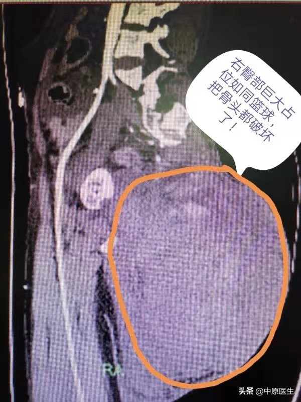 屁股上长个瘤怎么治疗,屁股上长了个瘤20多年了