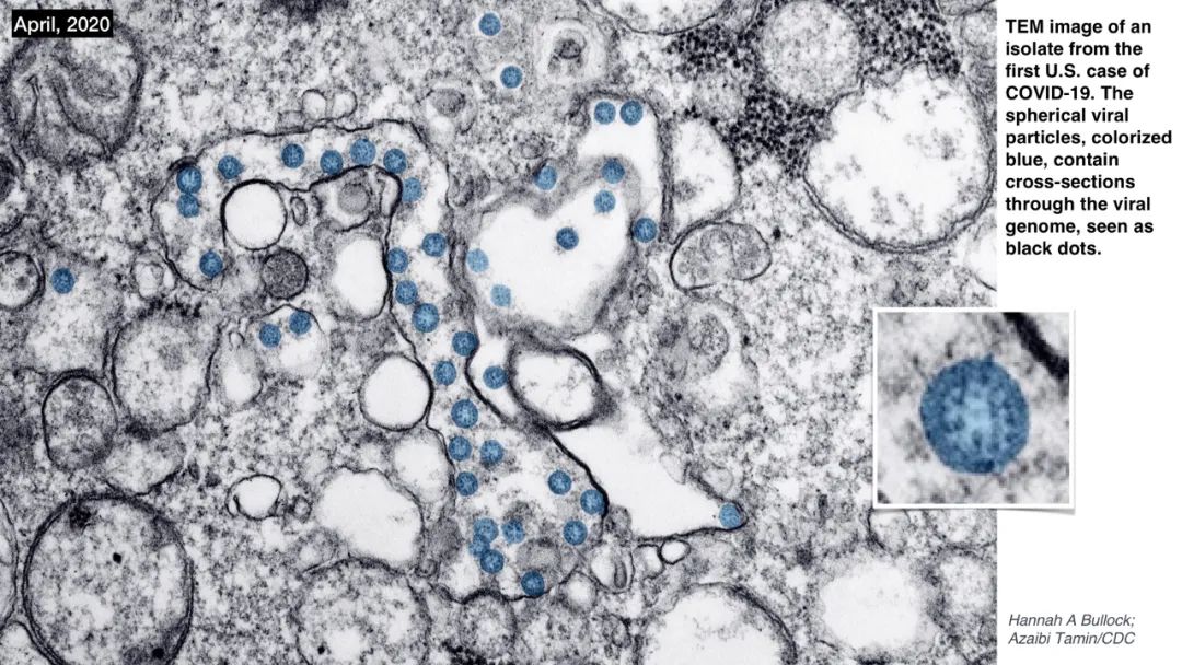 新冠病毒检测结果实验室解读,新冠病毒有哪些实验室检测方法