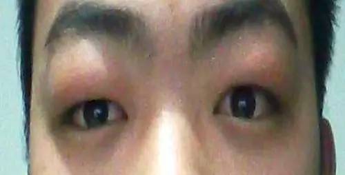 下眼睑黑眼圈特别严重是怎么回事,黑眼圈严重眼袋浮肿是什么原因