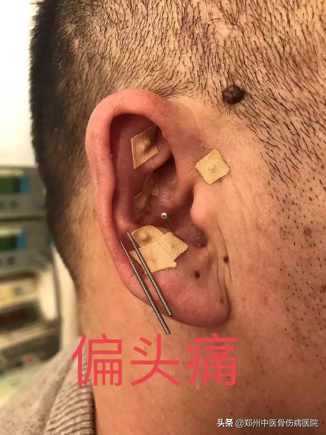 小耳朵大乾坤,耳穴的秘密中医