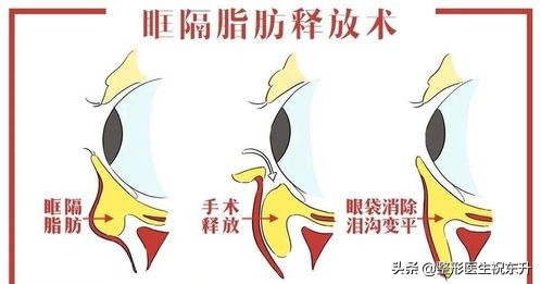医生不会说的|做眶隔脂肪释放祛眼袋手术缺点太多?