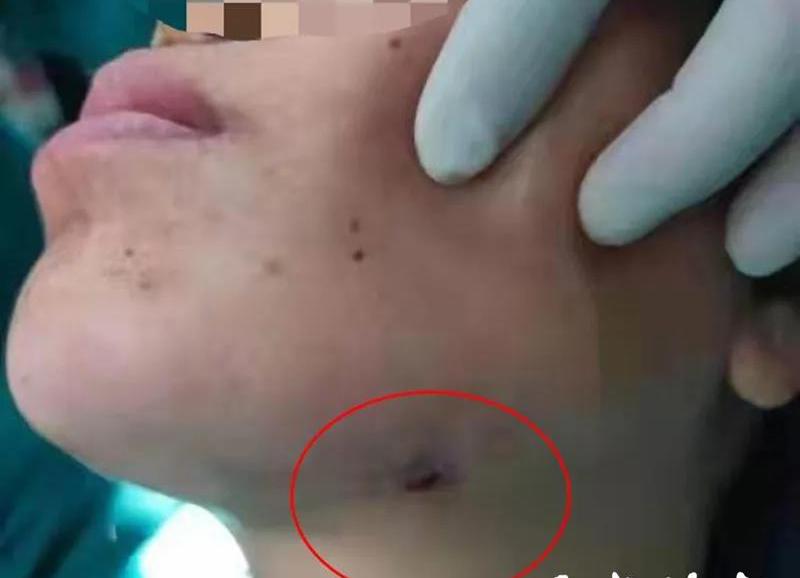 女性智齿发炎是什么原因,一个女孩智齿反复发炎的新闻