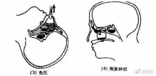 急性鼻窦炎和慢性鼻窦炎的区别,慢性鼻窦炎用什么消炎药有效果