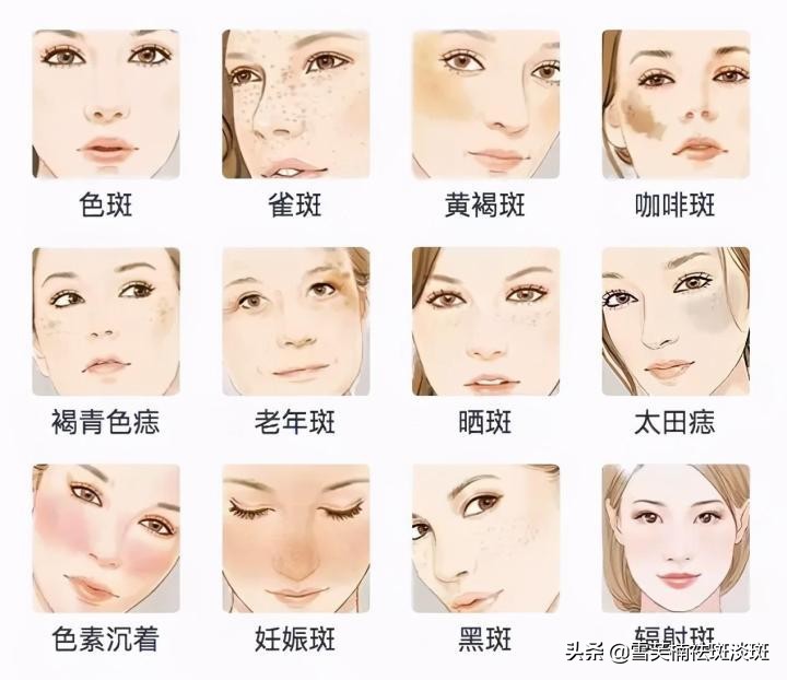 如何祛斑有效的方法,祛斑祛痘印有效的方法