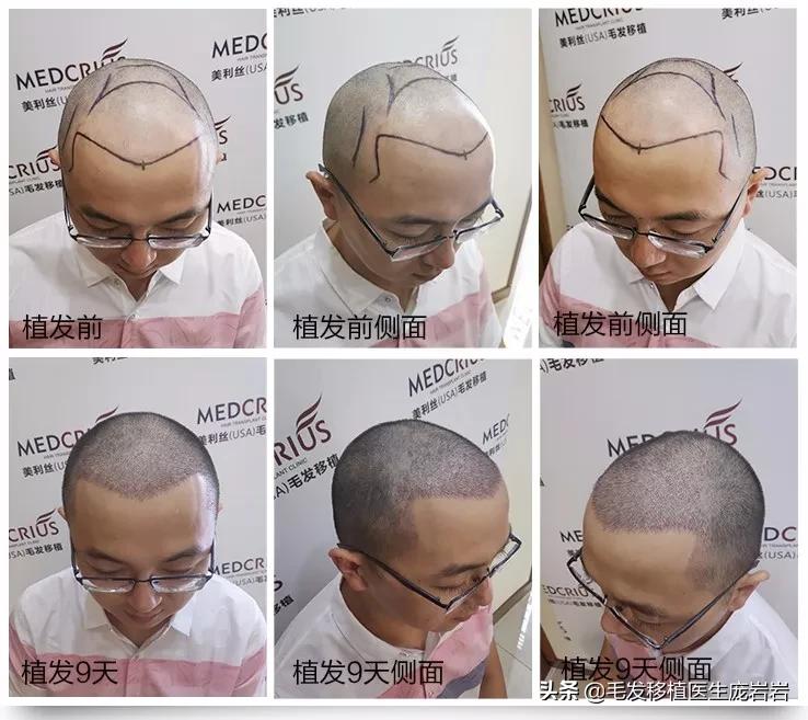 做这个动作轻松改善,做什么操可以防止脱发