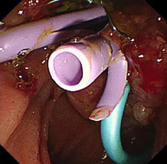 老年人肠梗阻疼痛难忍,老年人腹部剧痛