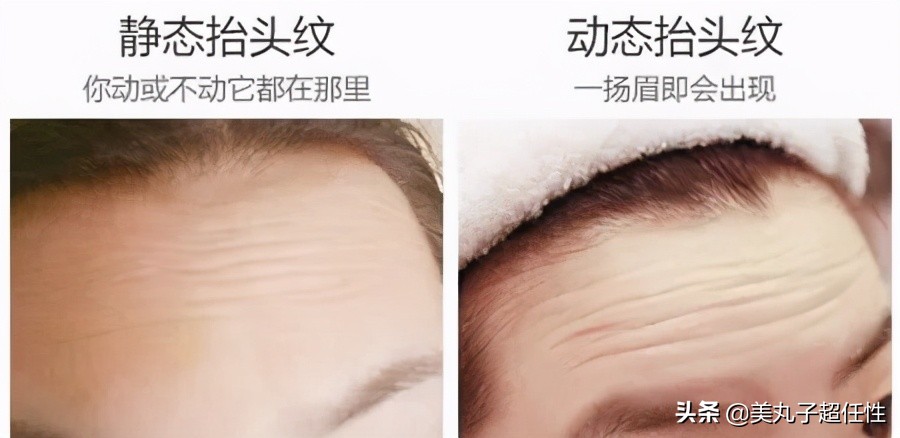 抬头纹最佳解决方法医美,教你一招解决抬头纹