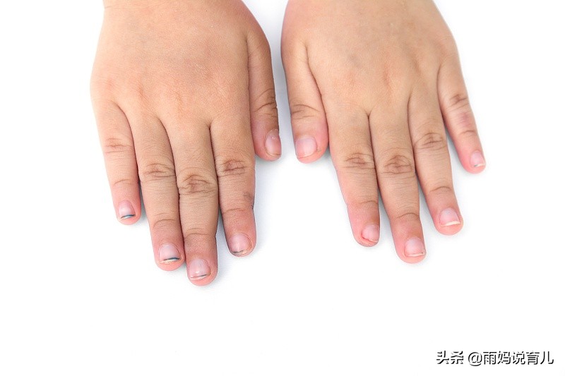 指甲白色缺钙,指甲盖上有白点是有蛔虫的意思吗