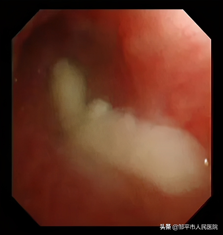 重症肺炎最佳治疗方法,满月宝宝重症肺炎如何治疗