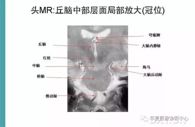 mra头颅解剖学详细讲解视频,常见的头颅mri图像