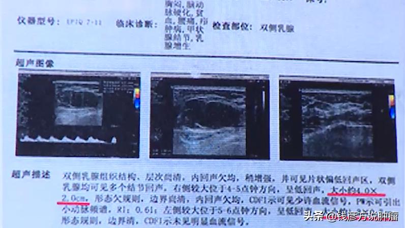 同时有乳腺结节子宫肌瘤胆囊息肉,乳腺结节子宫肌瘤中医辨证