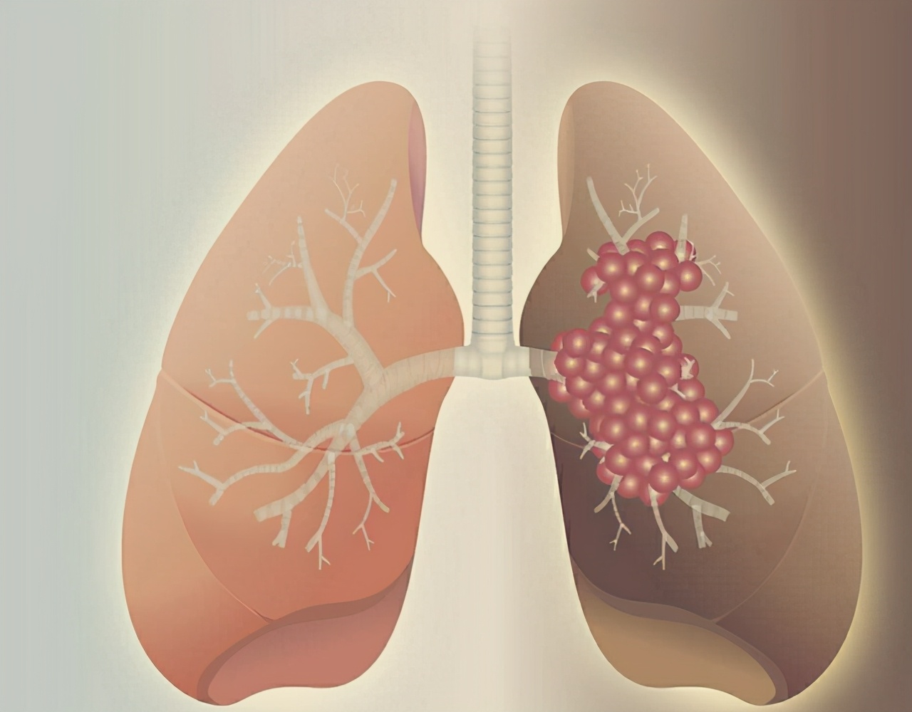 青梅竹马的妻子癌症,青梅竹马女友因乳腺癌走了