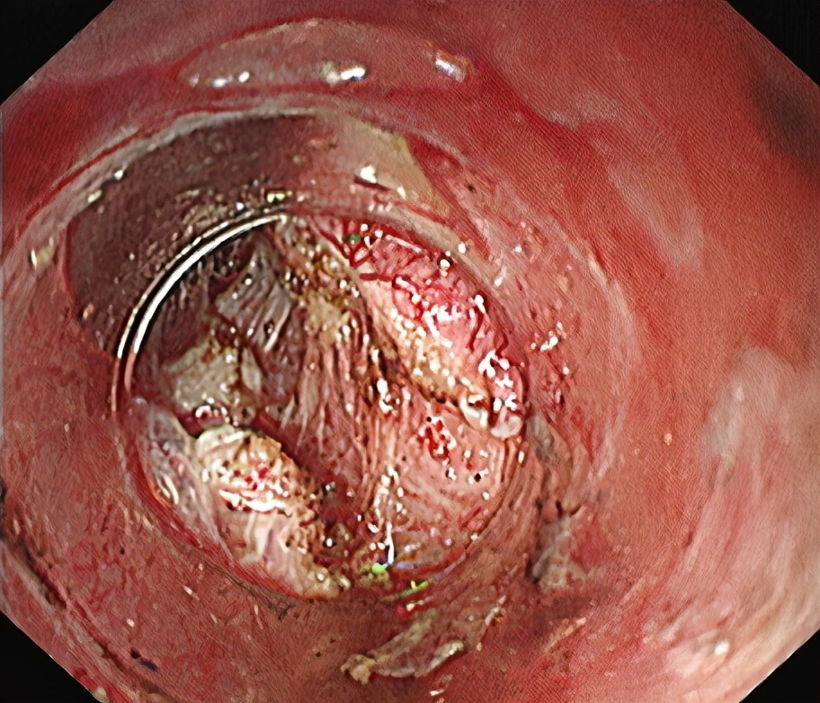 内镜下贲门失弛缓症微创手术,贲门失弛缓内镜治疗