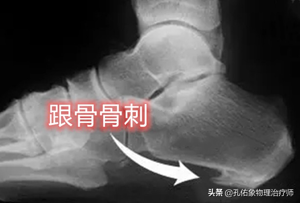 如何治疗足底筋膜炎缓解疼痛,足跟痛筋膜炎最佳的治疗办法