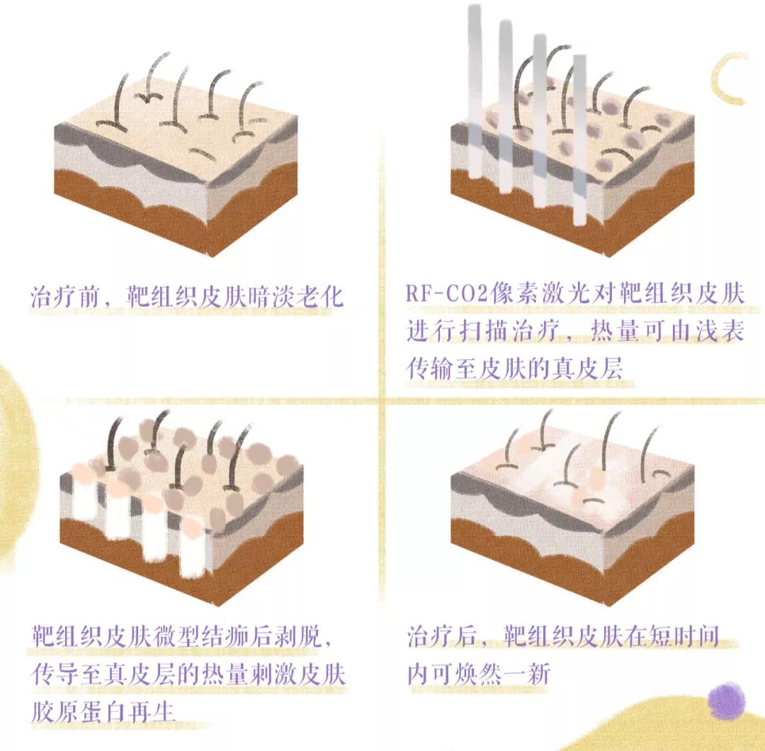医美做什么能永远不长痘,脸很多痘坑做什么医美