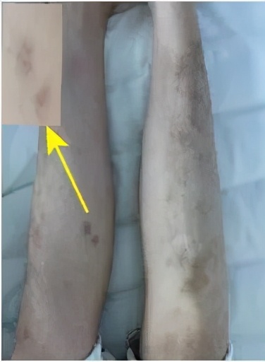 感冒哮喘用药不缓解,吃感冒药诱发哮喘