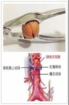 出现血尿就真的患了肾脏疾病吗?