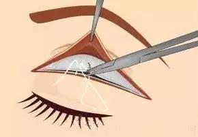 全切无痕割双眼皮,全切双眼皮原来是这么割出来的