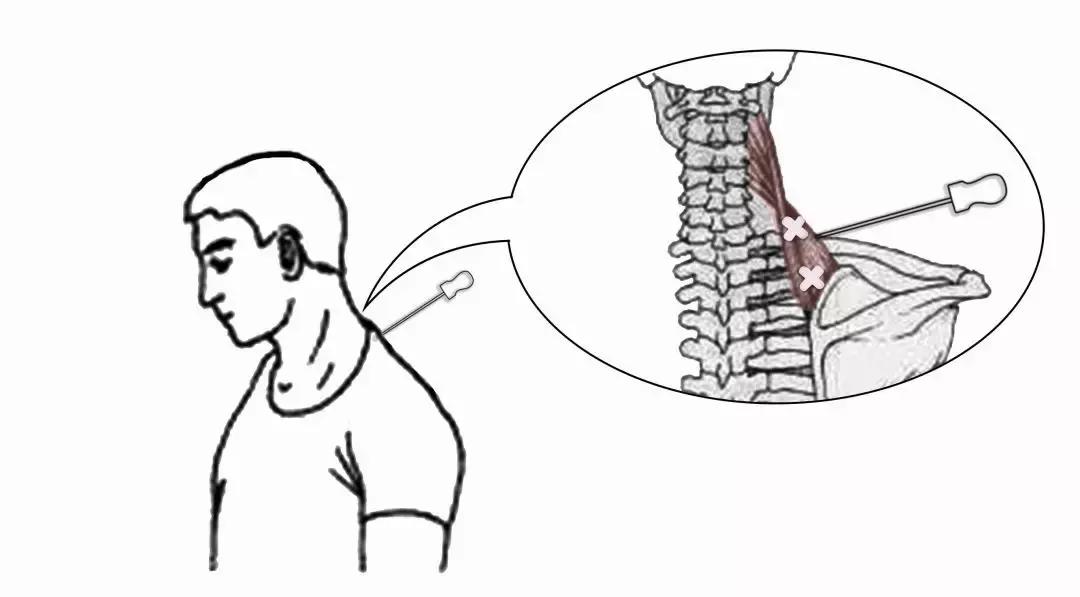 颈椎腰腿痛针刀,针刀颈椎病