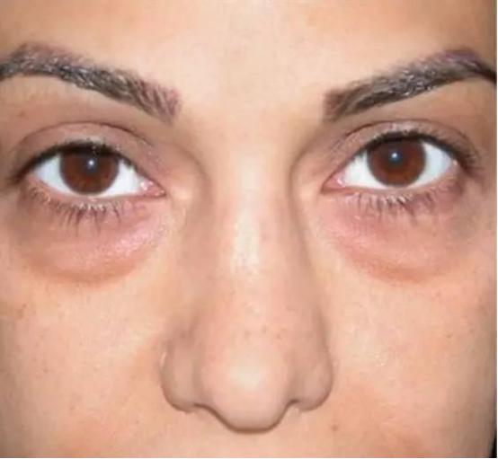 预防眼袋的正确方法16岁,怎样预防眼袋和黑眼圈