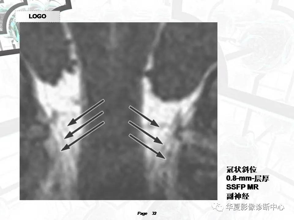 磁共振颅神经扫描是定位在哪,颅神经图谱