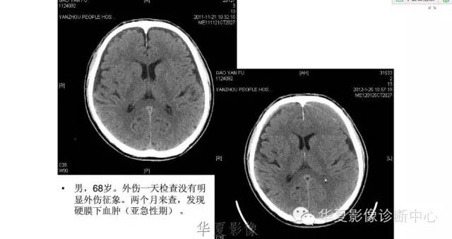一文读懂颅内胆脂瘤,一文看懂背后的真相