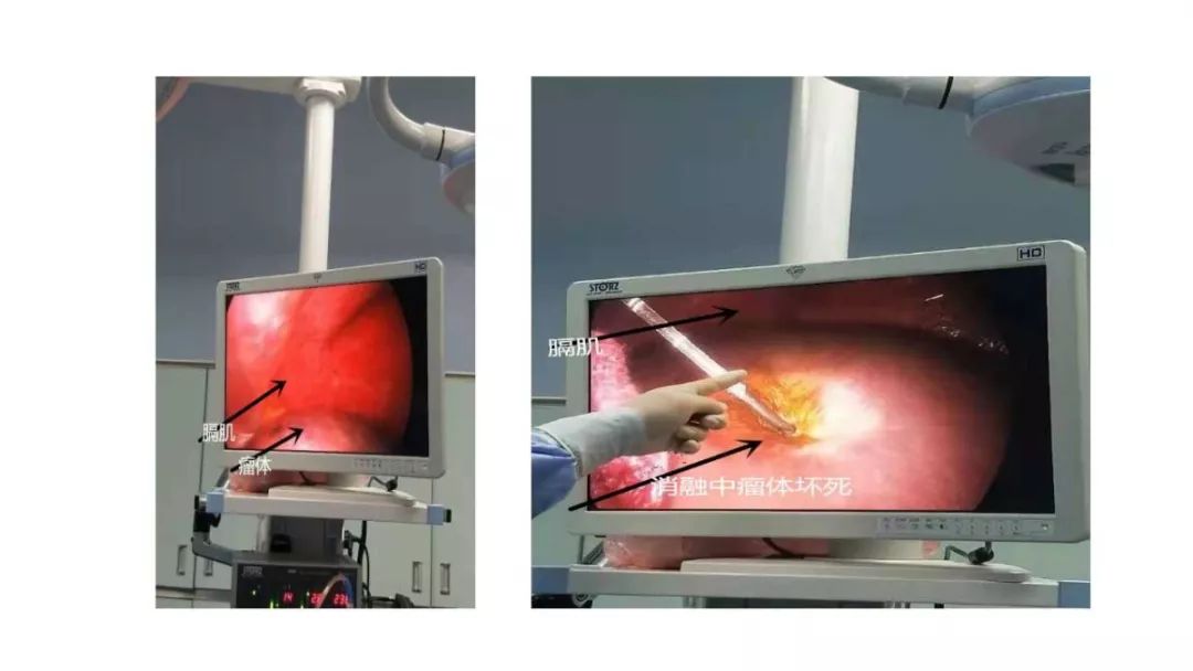 天津肝血管瘤射频消融术,肝血管瘤穿刺射频消融术