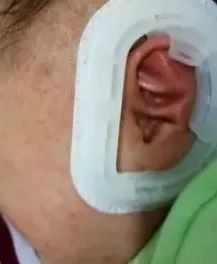 出生宝宝耳朵耳廓畸形判断,新生婴儿耳廓畸形圆耳