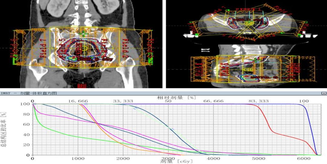 放疗内外照射同时进行吗,宫颈癌辅助放疗和根治性放疗