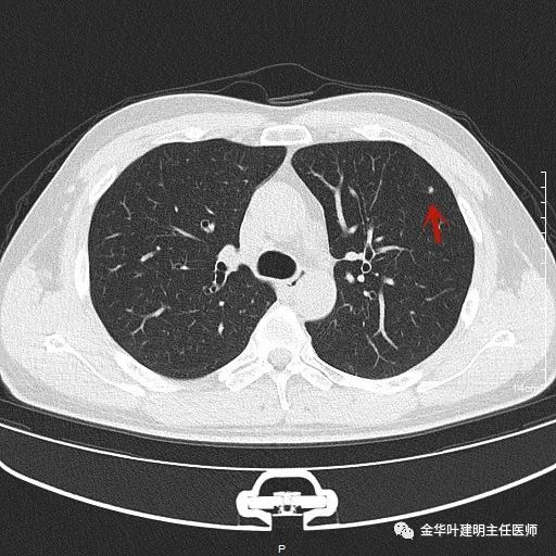 叶建明谈实性结节,叶建明肺实性良性结节会变癌症吗