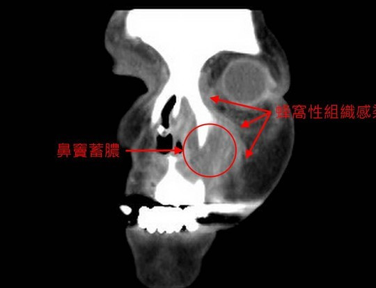 急性鼻窦炎擤鼻涕造成眼睛充血,鼻涕怎么擦才能擦得干净