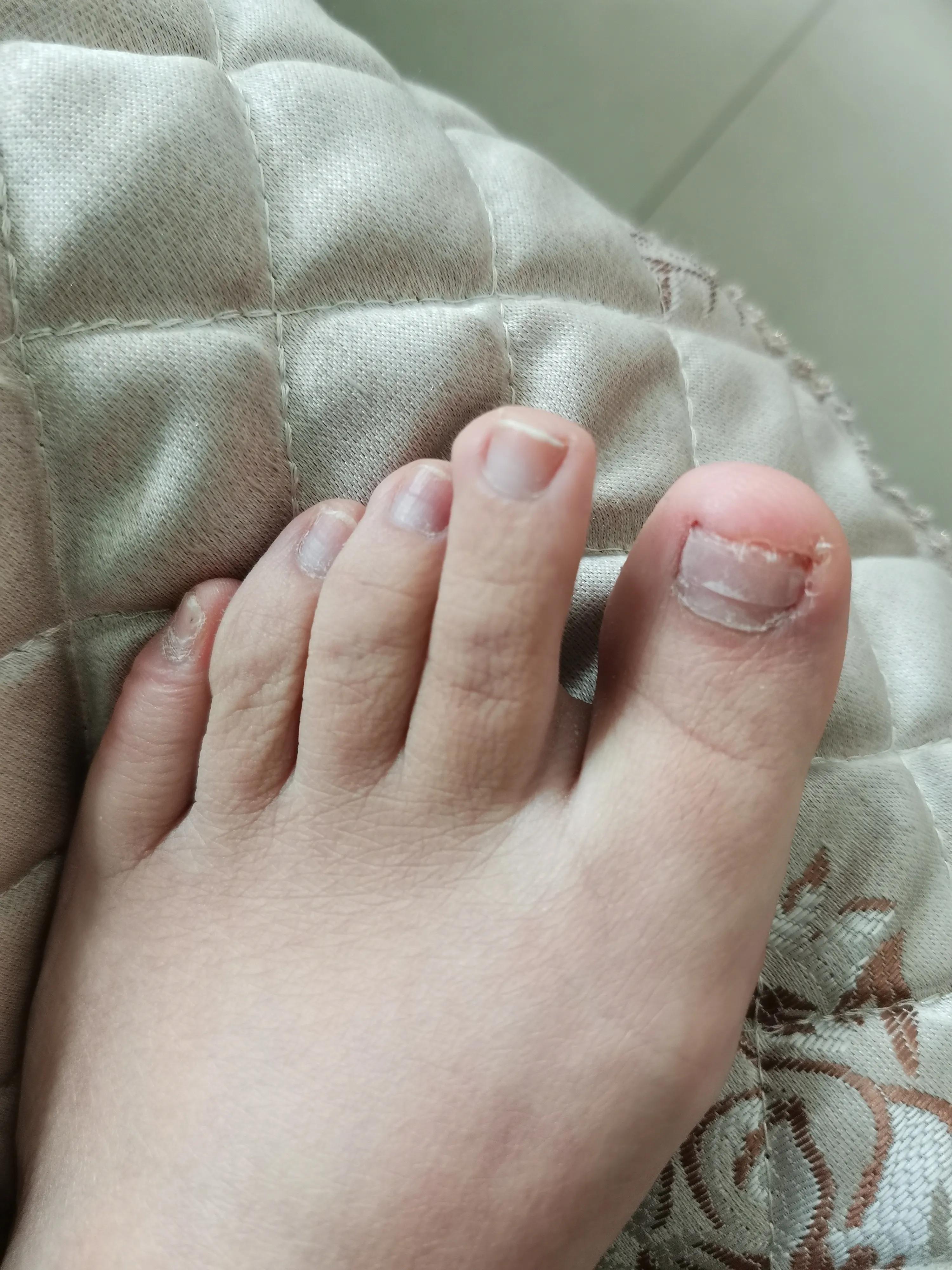 灰指甲加嵌甲治疗大概需要多少钱,灰指甲嵌甲怎么根治