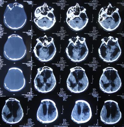 脑受伤开颅手术昏迷,开颅手术后20天发生脑积水引流