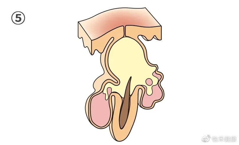 你以为的黑头真的是黑头吗,讨厌的黑头真的会变成草莓鼻吗