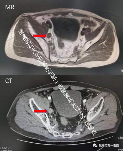 泉州第一医院手术,泉州二院微创手术