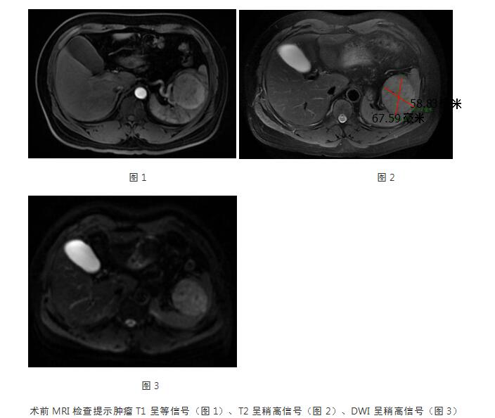 脾脏肿瘤需要把脾全部切除吗,脾脏血管瘤切除脾脏有什么影响