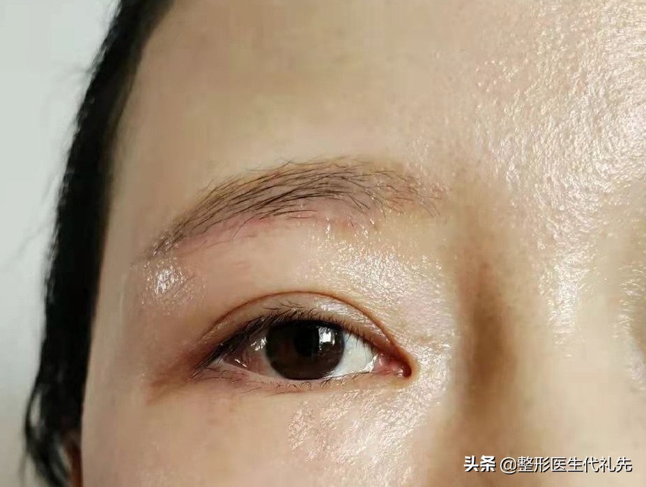 提眉手术疤痕凹凸不平,提眉手术后红肿怎么办