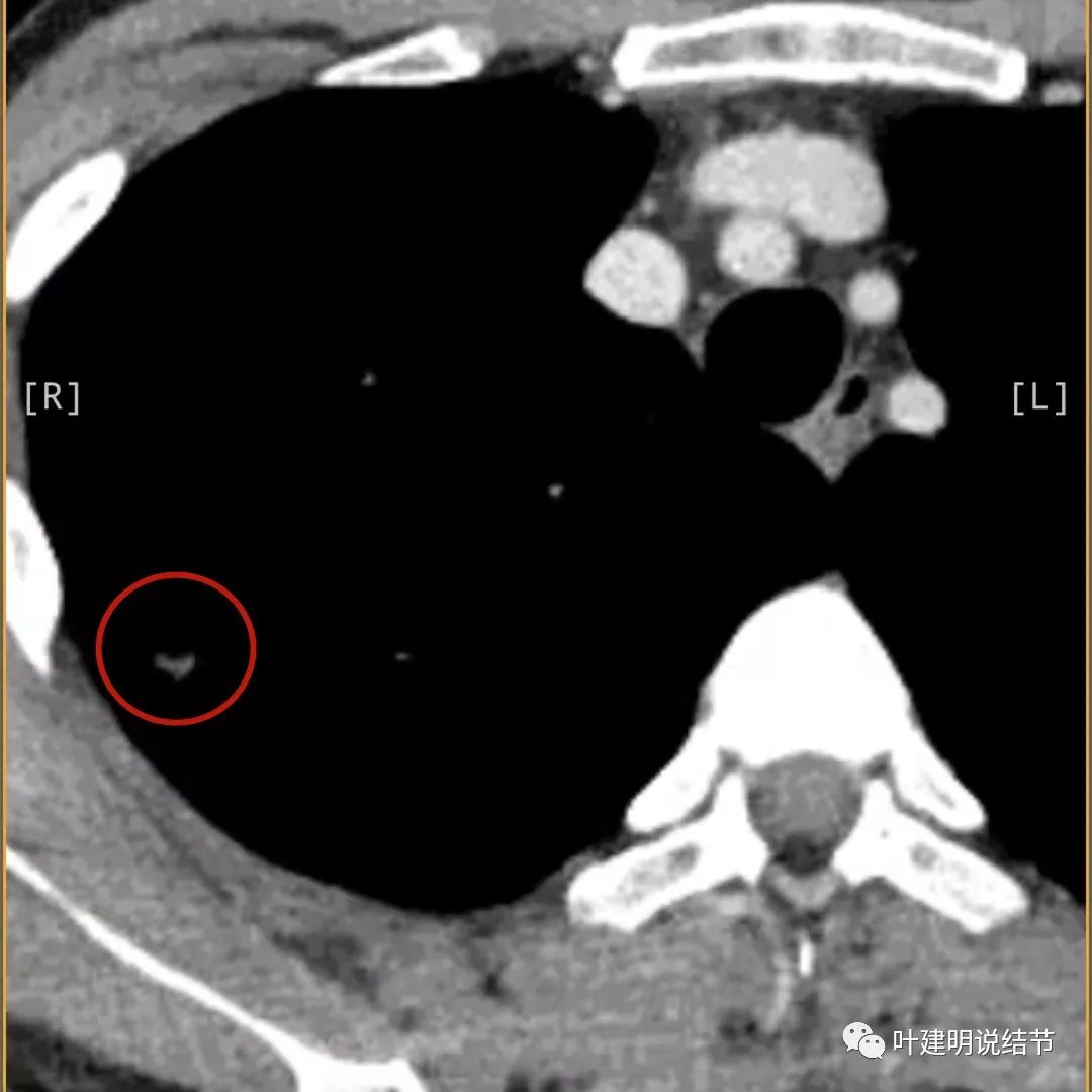 临床诊断孤立性肺结节,空洞型结节一般是什么性质