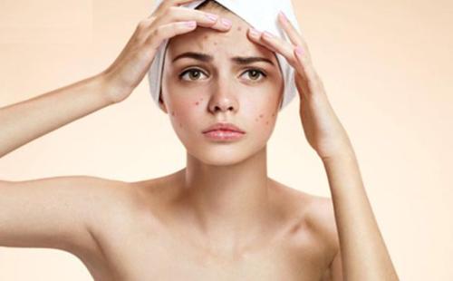 脸上长痘痘位置与器官,脸上不同位置长痘痘的原因