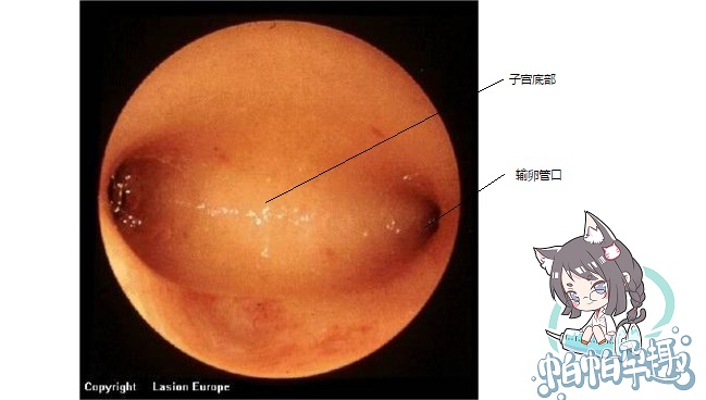宫腔镜片子一般有几个图像,不学医的话懂看诊流程吗