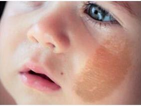 常见皮肤色斑有哪些怎么鉴别,面部色斑的鉴别诊断视频