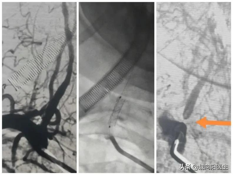 老人血管狭窄能活多久,头血管狭窄严重是否可以保守治疗