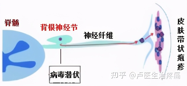 带状疱疹的中西医结合治疗法,我是大医生带状疱疹正确治疗方法