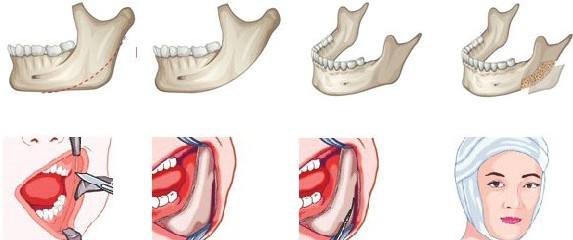 磨骨手术属于几级手术,揭秘神秘的手术室
