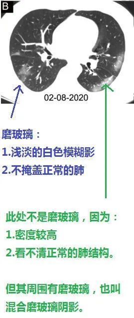 磨玻璃阴影怎么处理,磨玻璃阴影