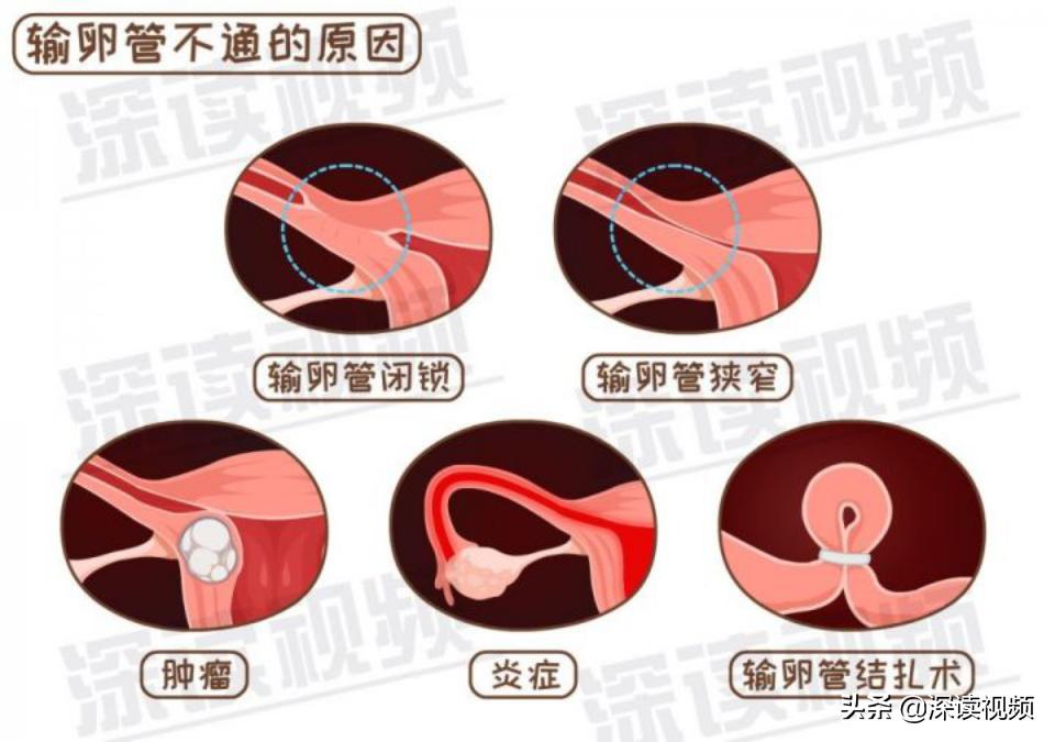 宫外孕一直流血怎么回事,宫外孕是怎么回事呢