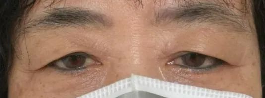 眼整形常见手术方式,眼整形美容手术