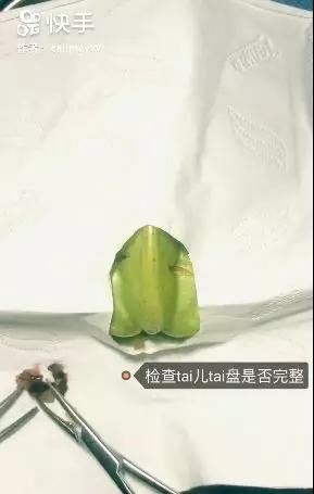 香蕉割包皮,洋葱剖腹产?这是我见过最秀的医生