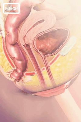 生完孩子后不剪胎盘,女人生完孩子切除子宫有什么影响