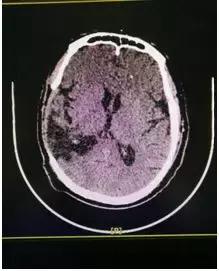 颅骨缺少3厘米不修补的影响,颅骨少了一小块有必要补吗